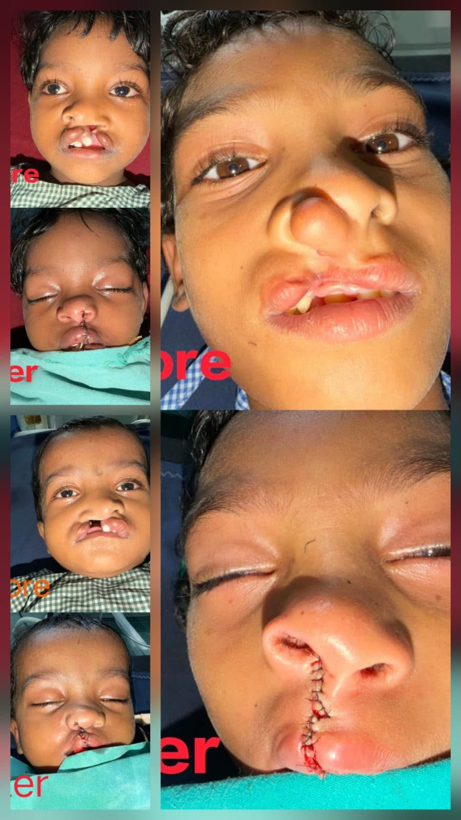 चिरायु योजना से बीजापुर के तीन बच्चों के चेहरों पर लौटी मुस्कान